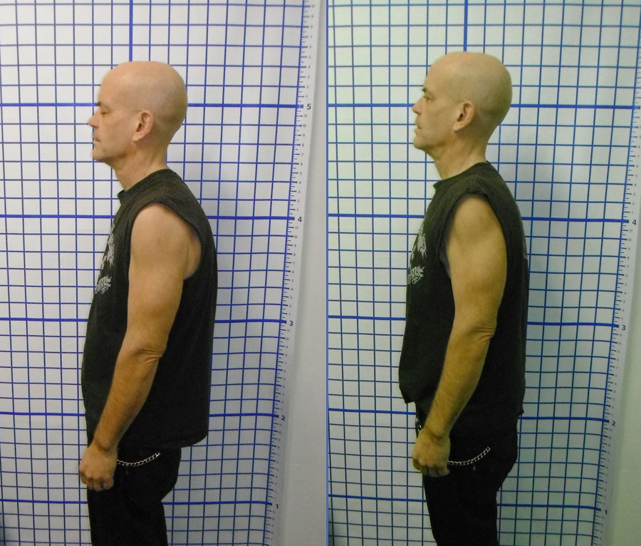 Posture Before And After Chiropractic Adjustment