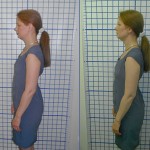 Before-After-ABC-Chiropractic-Nyack-4