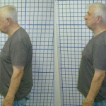 Before-After-ABC-Chiropractic-Nyack-5